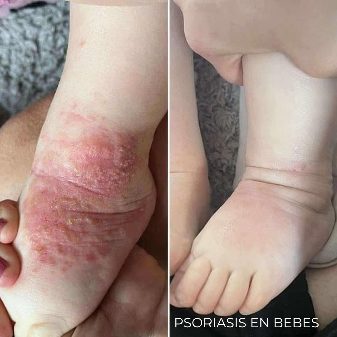Diabeskin - Crema humectante para Psoriasis