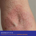 Kit Dermatitis Diabeskin