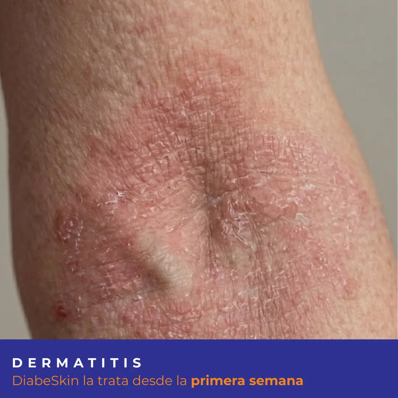 Kit Dermatitis Diabeskin