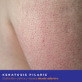 Kit Keratosis Pilaris Diabeskin
