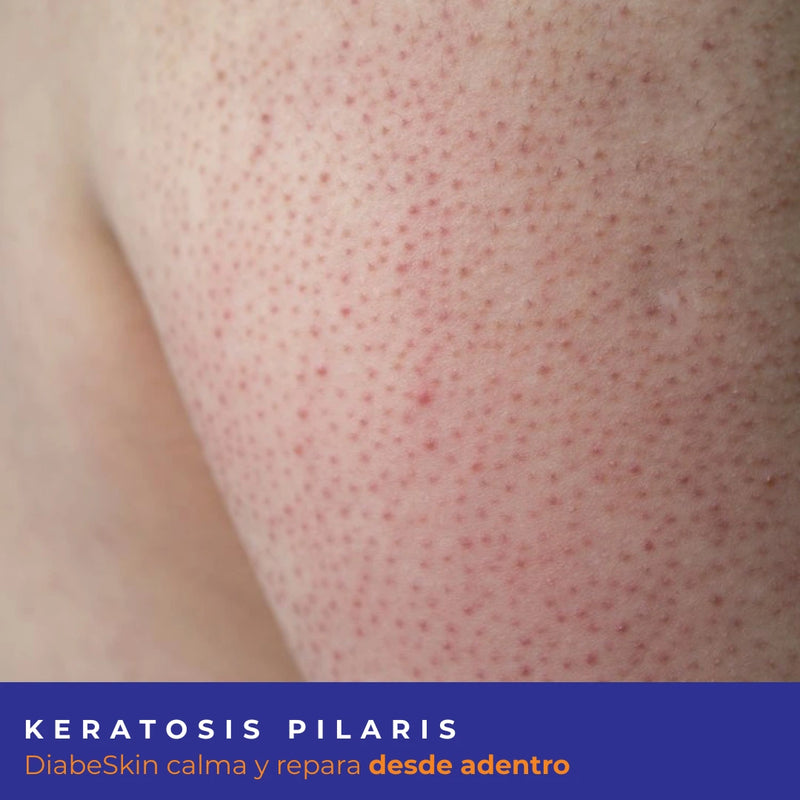 Kit Keratosis Pilaris Diabeskin