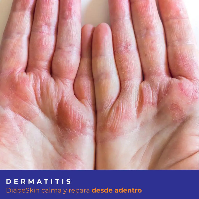 Kit Dermatitis Diabeskin