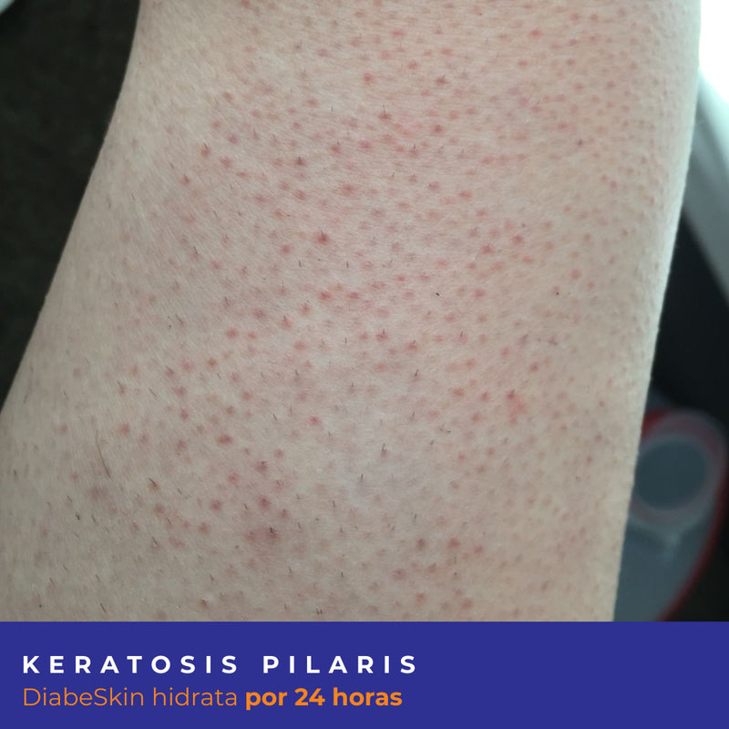 Kit Keratosis Pilaris Diabeskin
