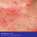 Kit Dermatitis Diabeskin
