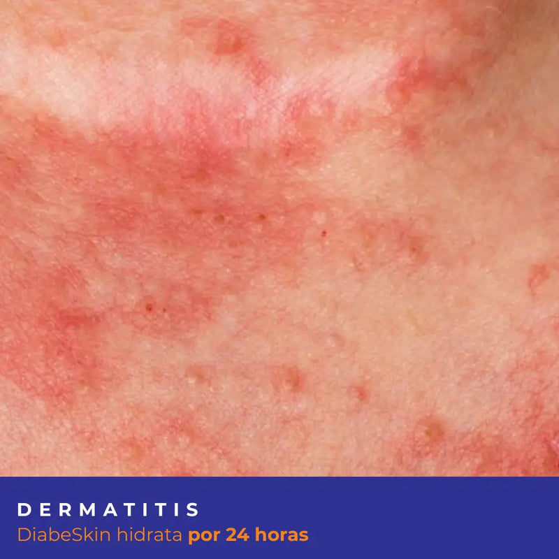 Kit Dermatitis Diabeskin