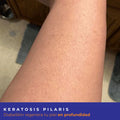 Kit Keratosis Pilaris Diabeskin