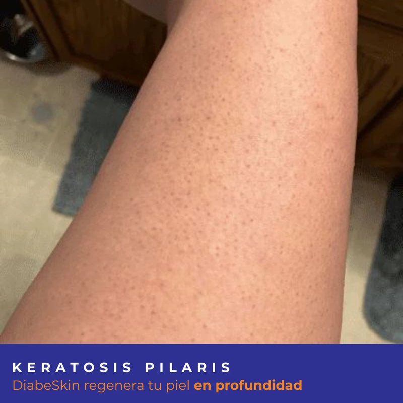 Kit Keratosis Pilaris Diabeskin
