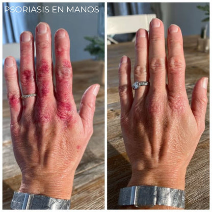 Diabeskin - Crema humectante para Psoriasis