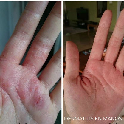 Diabeskin - Crema humectante para Dermatitis