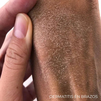 Diabeskin - Crema humectante para La Resequedad