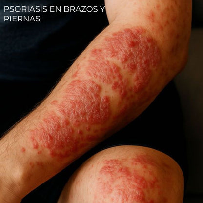 Diabeskin - Crema humectante para Psoriasis