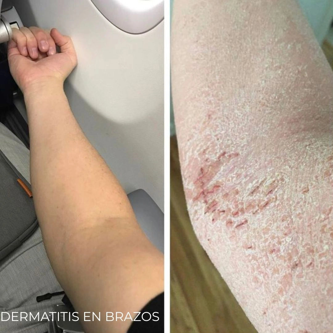 Diabeskin - Crema humectante para Dermatitis