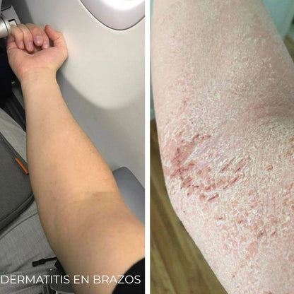 Diabeskin - Crema humectante para Dermatitis