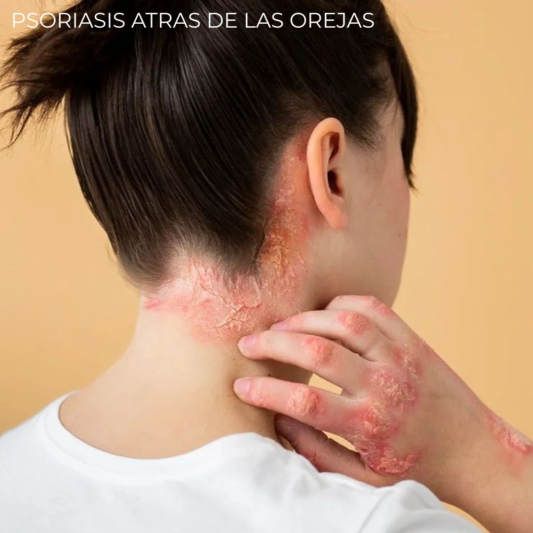 Diabeskin - Crema humectante para Psoriasis