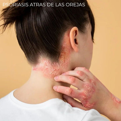 Diabeskin - Crema humectante para Psoriasis