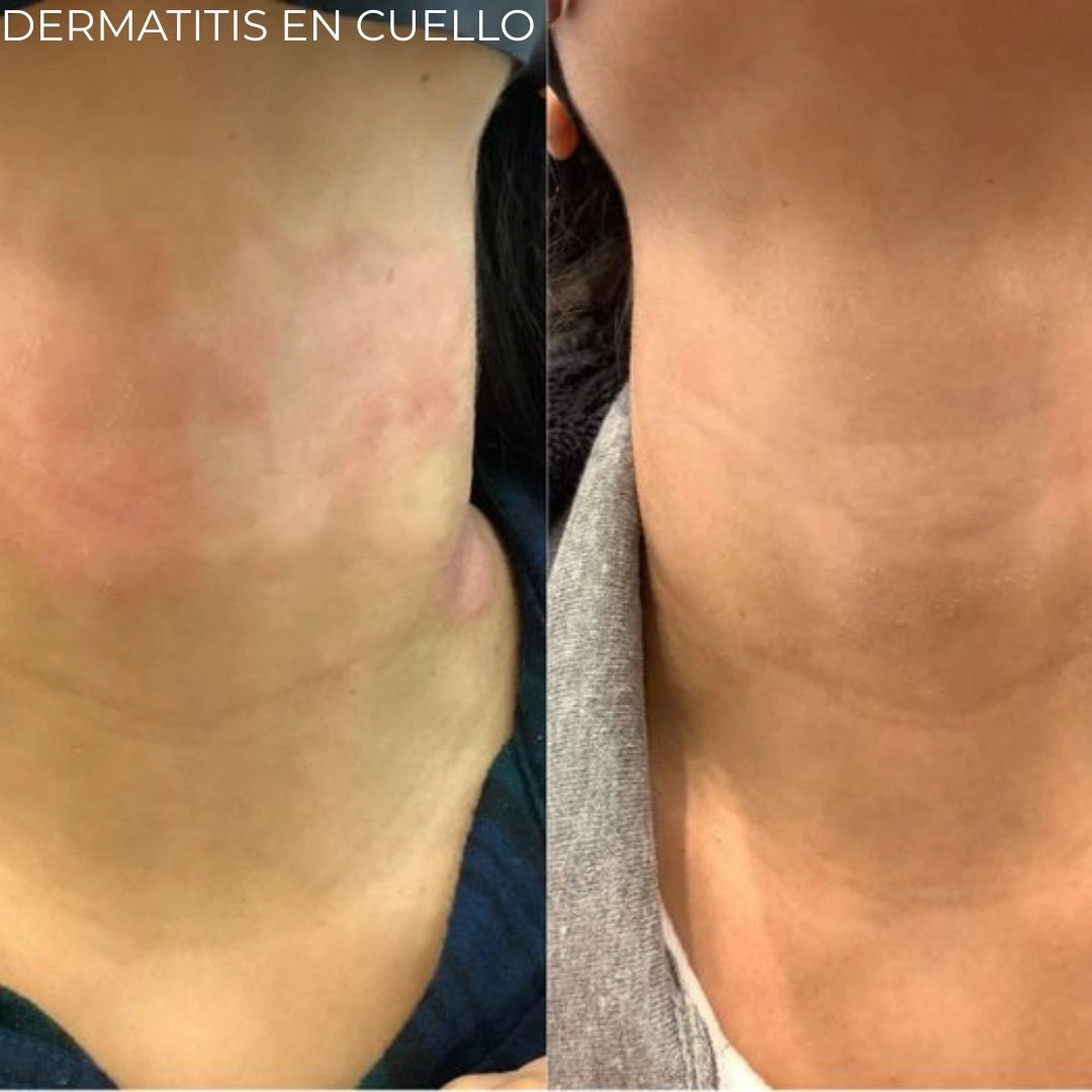 Diabeskin - Crema humectante para Dermatitis