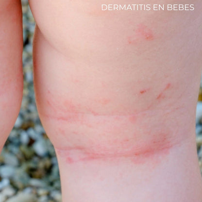 Diabeskin - Crema humectante para Dermatitis