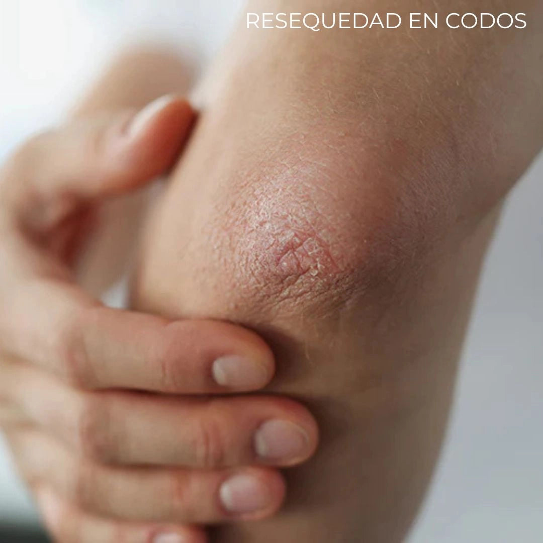 Diabeskin - Crema humectante para La Resequedad