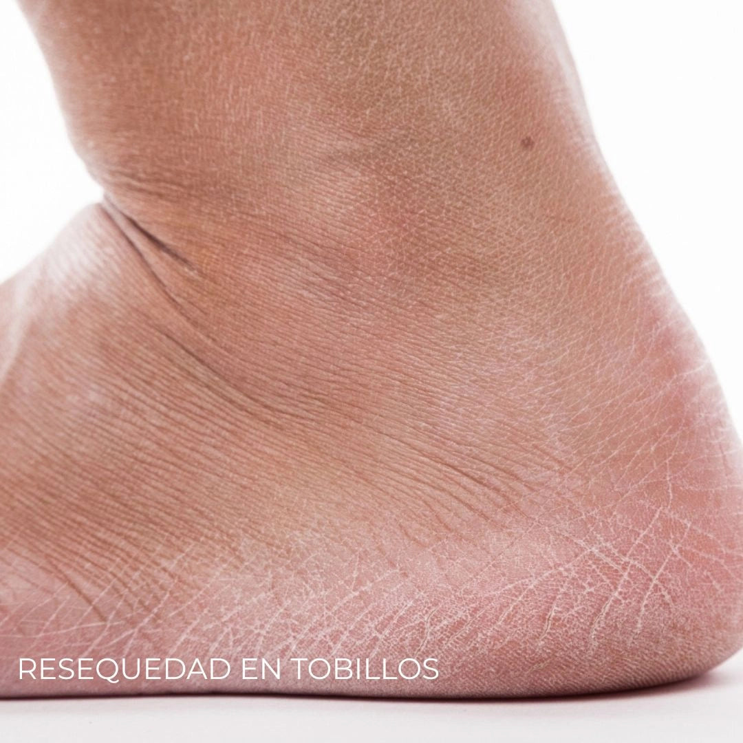 Diabeskin - Crema humectante para La Resequedad