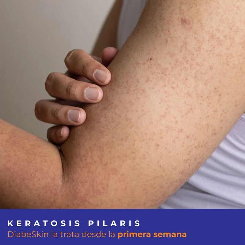 Kit Keratosis Pilaris Diabeskin