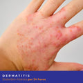 Kit Dermatitis Diabeskin