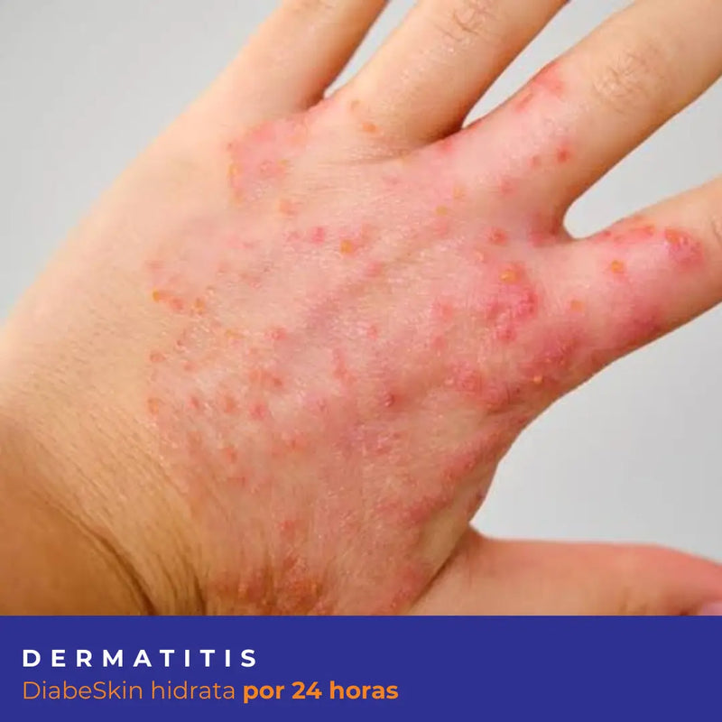 Kit Dermatitis Diabeskin